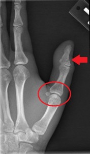 I have amazing MS Paint skills. Circle = avulsion fracture. Arrow = fracture.