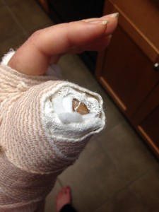 Some have said it looks like my thumb was amputated. It's still there! It's just encased in plaster because I also broke the upper part of the bone.